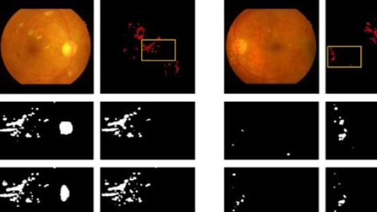 Hard Exudate Detection with Supervised Contrastive Learning