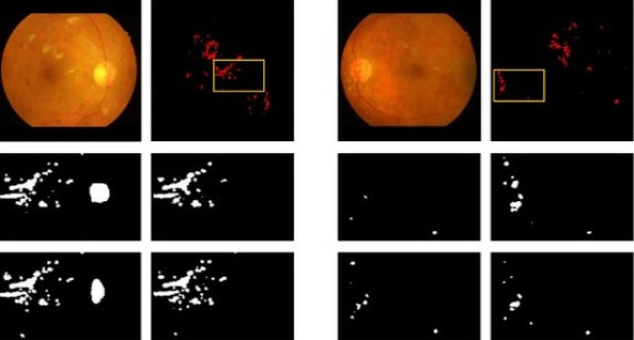 Hard Exudate Detection with Supervised Contrastive Learning
