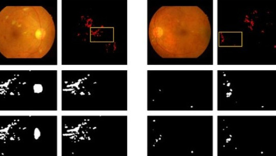 Hard Exudate Detection with Supervised Contrastive Learning